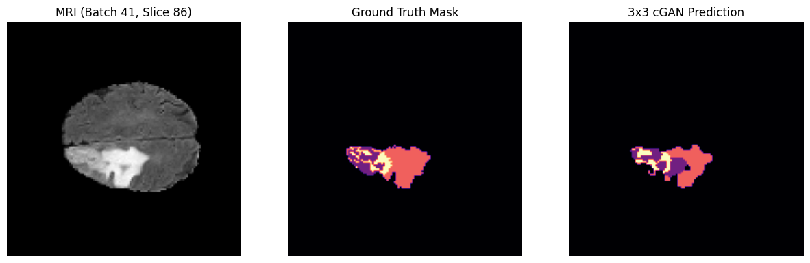 One row: MRI slice, ground truth mask and 3x3 PatchGAN cGAN prediction, with visibly rougher region boundaries.