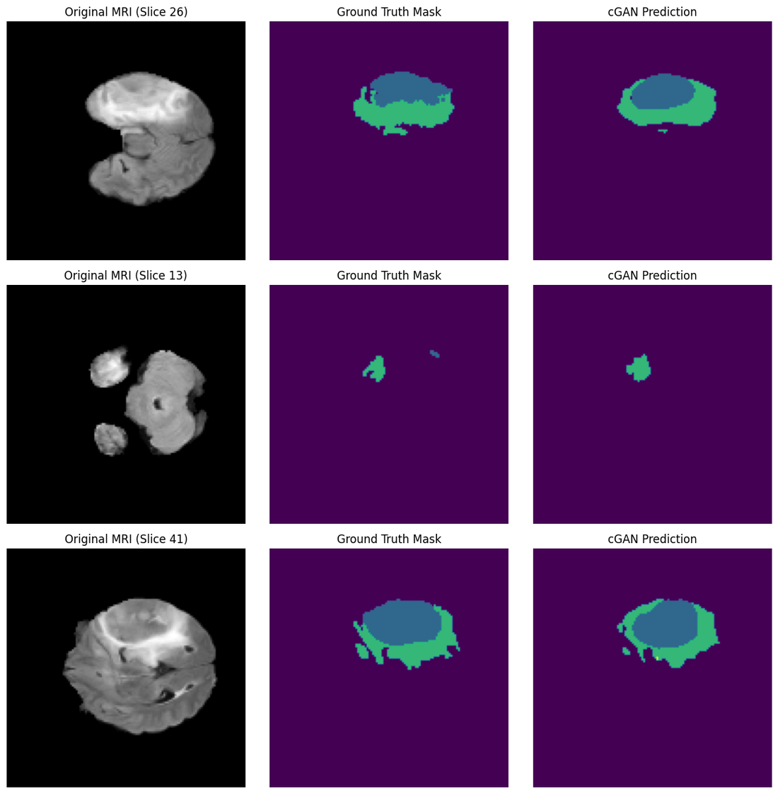 Three rows, each showing an axial MRI slice, the expert ground-truth mask and the Model D prediction. Predicted core and edema regions closely follow the annotation.