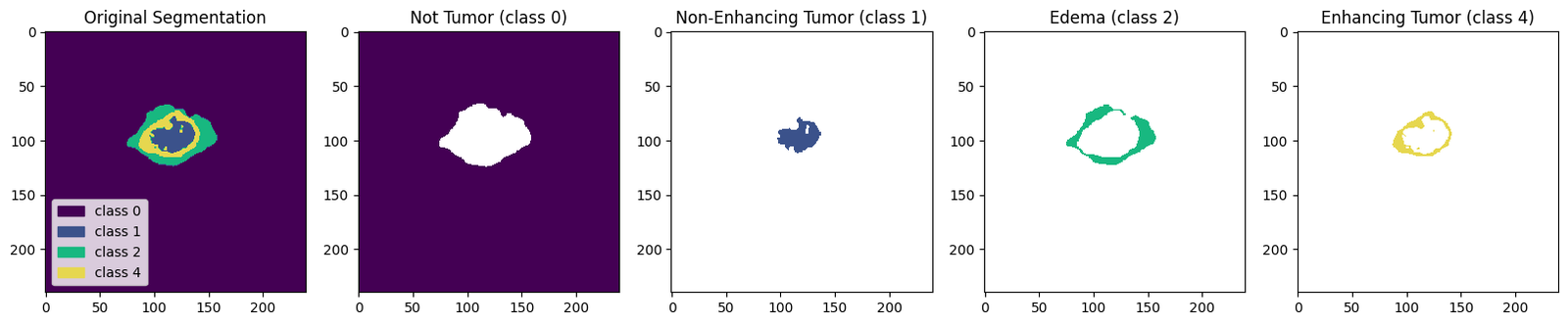 Five panels isolating each segmentation class in turn: full mask, background, non-enhancing tumour, edema, enhancing tumour.