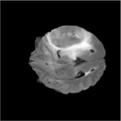 Axial T2-FLAIR MRI slice of a brain with a large bright lesion in the right frontal lobe.